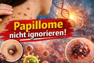 Papillome entfernen – Ursachen, HPV Symptome und meine persönliche Erfahrung